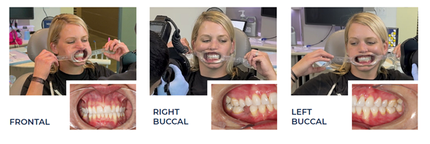 ndx-aligners-patient-photos
