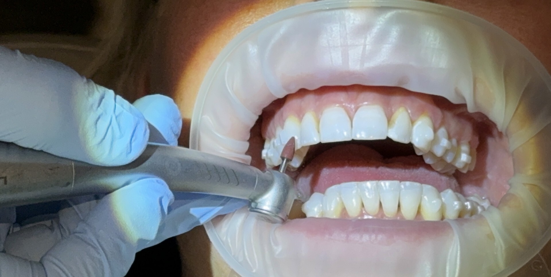 ndx clear aligners importance of attachments
